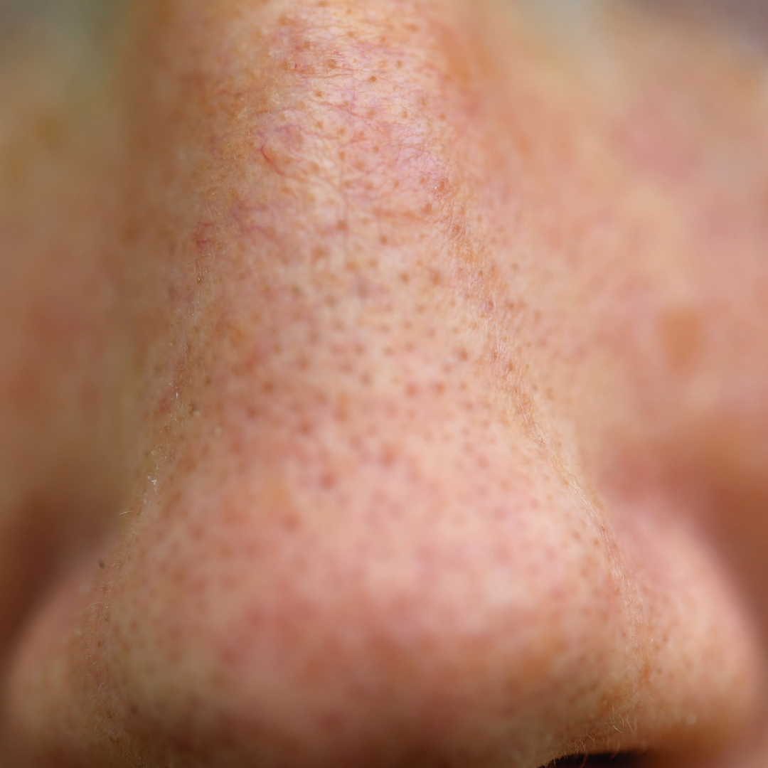 How to Get Rid of Clogged Pores?